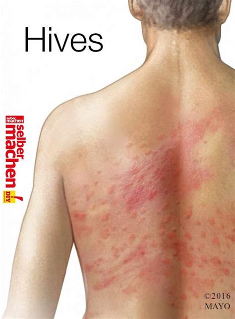 Anyone Can Develop Chronic Hives But Theyre More Common In Middle