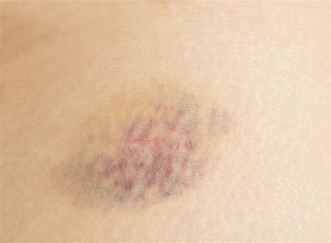 Bruises On The Legs Stock Image Image Of Healthy Injury 176645403