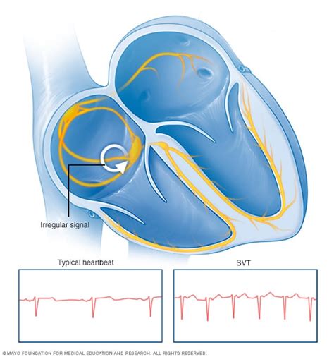 Supraventricular Tachycardia Symptoms And Causes Mayo Clinic