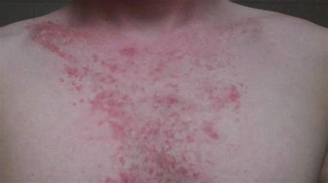 Rash On Chest Type Symptoms Causes And Treatments