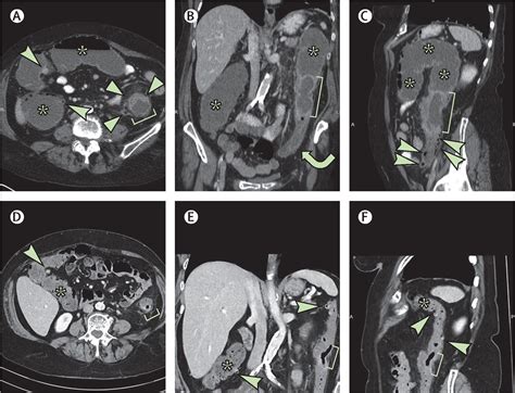 Intramural Abscess Of The Large Bowel In Acute Diverticulitis