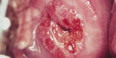 (12) • biasanya sebagian besar infeksi akan sembuh dengan sendirinya namun kadang bisa menjadi • memberikan perlindungan yang adekuat terhadap infeksi hpv penyebab kanker serviks. Kanker Serviks; Sembuh 100% Bila Terdeteksi Dini ...
