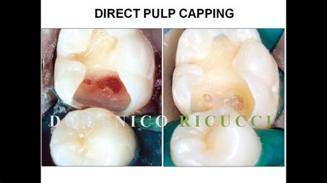 Deep Caries With Clinical Pulp Exposure 😮 Endodontist Dr Domenico