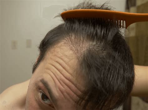Before And After Photos Of Hair Transplant Surgeries What Success And