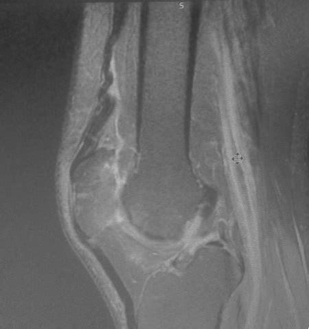Quadriceps Tendon Tear MRI Sumer S Radiology Blog