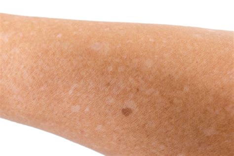 White Spots On Skin From Sun Causes Treatment And How To Prevent