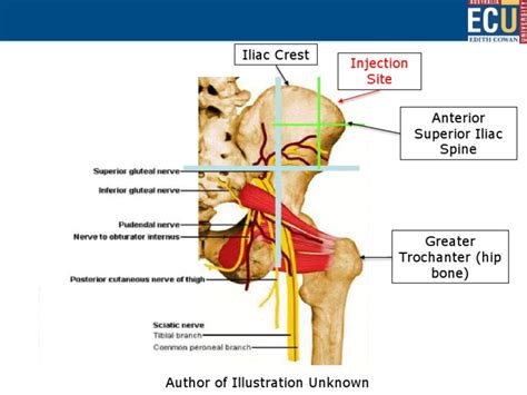 Ventrogluteal Im Injection Important Landmarks Pdf