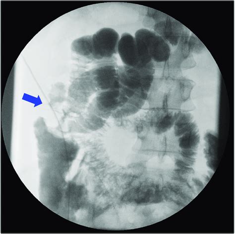 A Radiographic Contrast Enema Performed After The First Surgery A Long