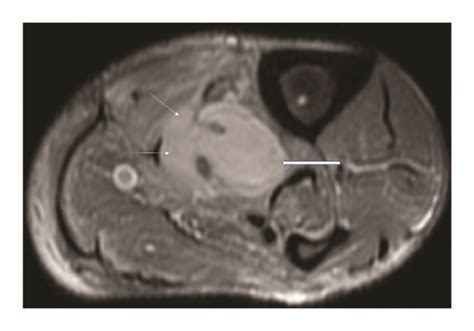 Axial T2 Weighted Fat Saturated Stir Mr Image Showing Loculated