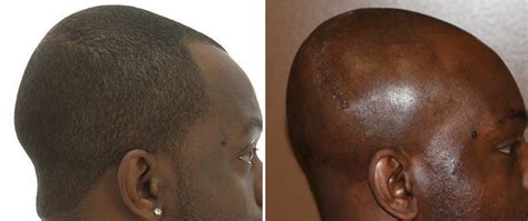 Occipital Skull Reduction Result Side View Dr Barry Eppley Indianapolis