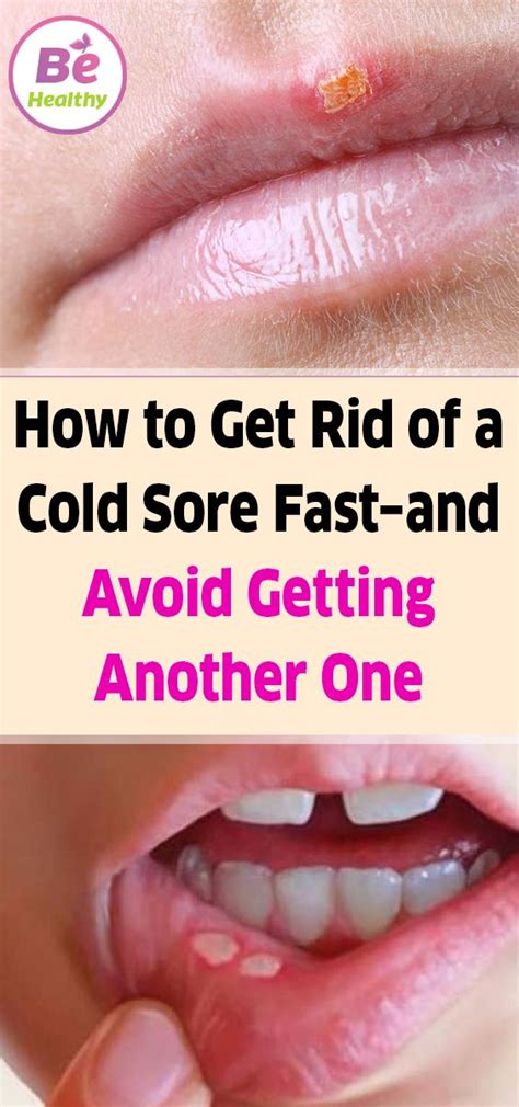 How To Get Rid Of A Cold Sore Fastand Avoid Getting Another One Diy