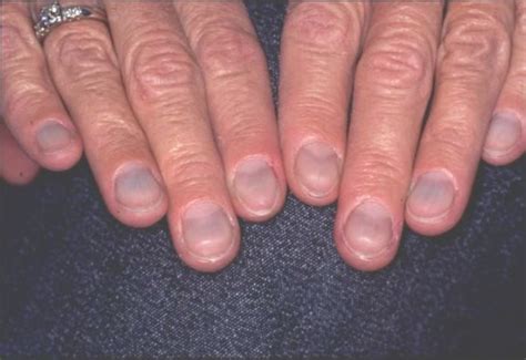 15 Health Warnings Your Fingernails Are Sending