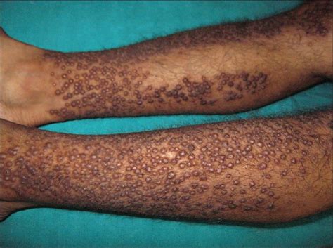 Bullous Pemphigoid