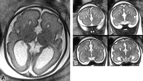 A Prospective Study Of Fetuses With Isolated Ventriculomegaly