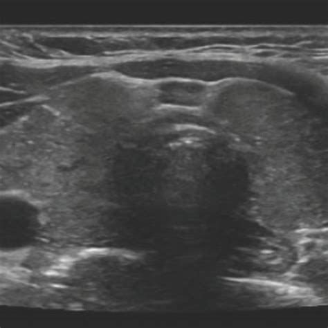 Thyroid Ultrasound Showing A Slightly Enlarged Thyroid Gland With