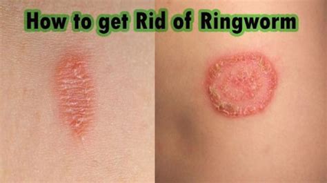 What Is Ringworm And How Long Is It Contagious Find Out More