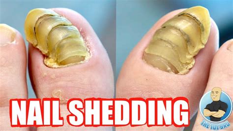 Most Interesting Toenails In The World Youtube