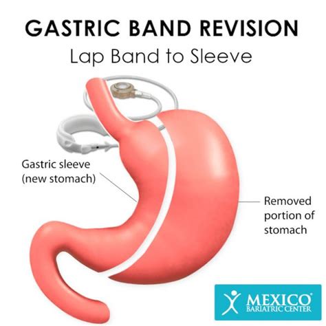 Lap Band Revision Surgery In Mexico Mexico Bariatric Center