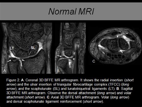 Figure 2 From Arthro Mri Findings On Tfcc Lesions And Intrinsic