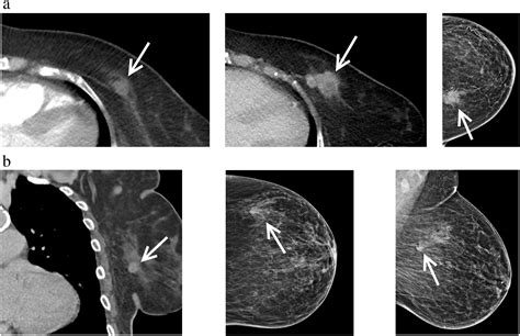The Chest Radiologist S Role In Invasive Breast Cancer Detection