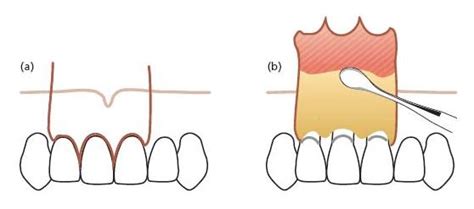 21 Surgical Endodontics Pocket Dentistry