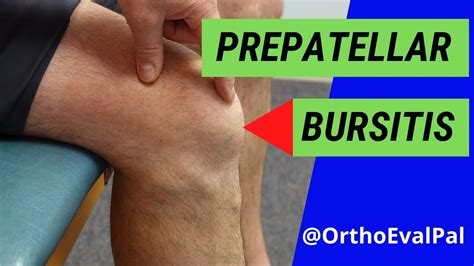 Prepatellar Bursitis Anterior Knee Pain And Swelling Youtube Sexiz Pix