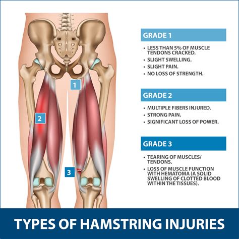 Hamstring Injury Recovery Florida Orthopaedic Institute