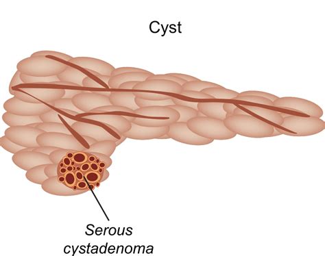 Pancreatic Cyst Gutcare