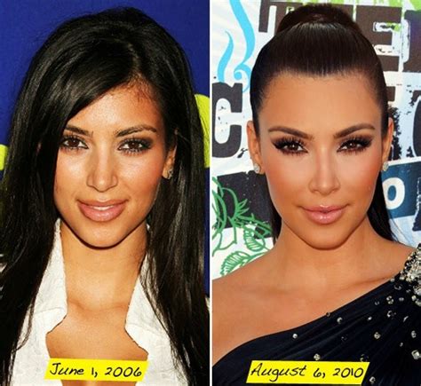 Kim Kardashian Plastic Surgery Before And After Nose Job Botox And