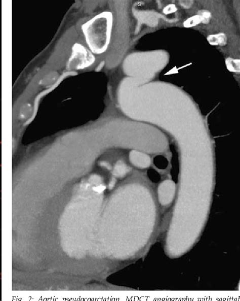 Figure 2 From Multidetector Computed Tomography In The Diagnosis Of