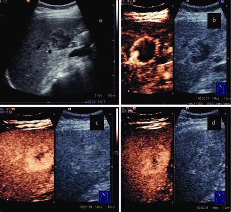 Ceus In A Benign Lesion Hemangioma A Conventional Ultrasound Download Scientific Diagram