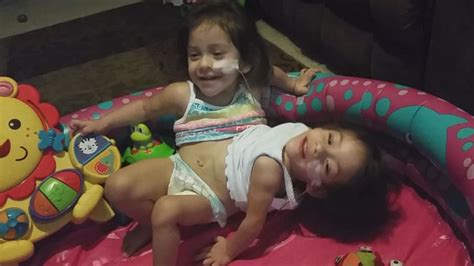 Video Conjoined Twin Girls Undergo Risky Separation Surgery Part 2