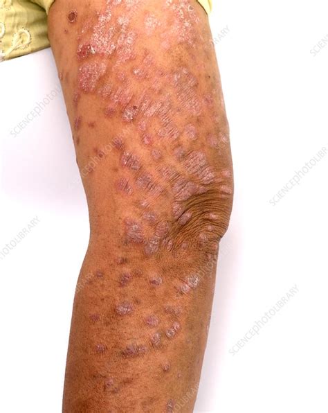 Psoriasis On The Upper Arm Stock Image C0372271 Science Photo