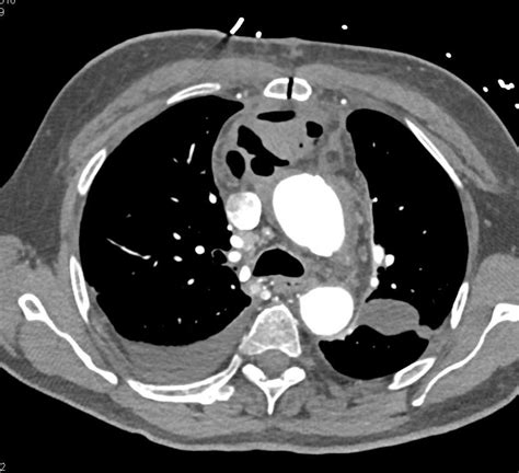 Mediastinal Abscess With Air Fluid Levels Chest Case Studies Ctisus