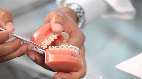 Spacers for braces pain relief here are ways to relieve pain from spacers: Braces: Broken Bracket, Poking Wire, Braces Pain - Aura ...