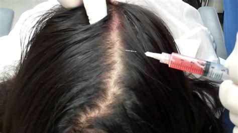 Hair restoration injection is a procedure in which growth factors from one's own blood are used to stimulate hair regrowth and increased thickness. Dr.Thomas Barnes' PRP Hair Growth and Skin Rejuvenation ...