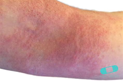 Atopic Eczema Online Dermatology