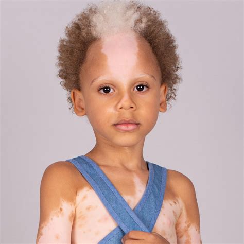A Brazilian Child With Unique And Distinctive Features Blossoms Into A