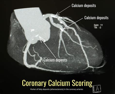 Ct Coronary Calcium Scoring — Sozocardiology Dr Ooi Yau Wei