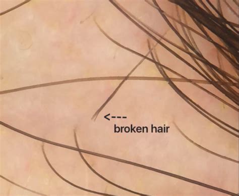 Exclamation Hairsbroken Hairs — Donovan Hair Clinic