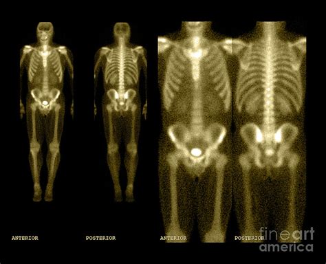 Bone Scan 6 Photograph By Medical Body Scans Fine Art America