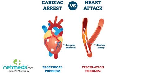 Cardiac Arrest Causes Symptoms And Treatment