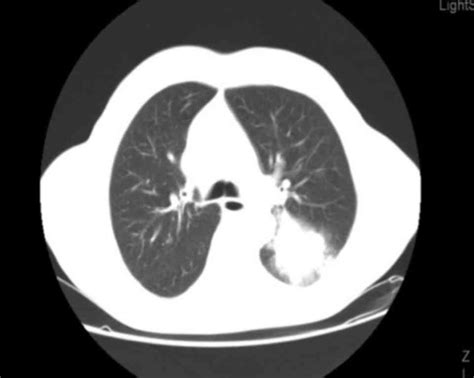 Long Term Survival In A Patient With Metastatic Squamous Cell Lung