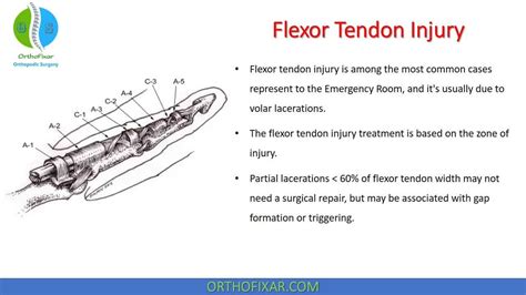 Finger Flexor Tendon Injuries Lacerations Zones Assessment Youtube My Xxx Hot Girl