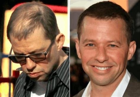 14 Celebrity Hair Transplants You Must See Bald And Beards