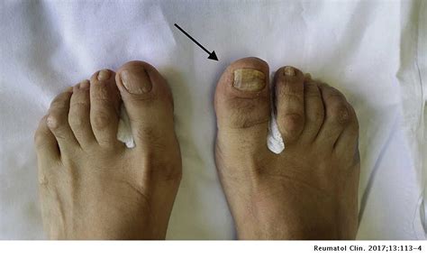 Psoriatic Arthritis Toes