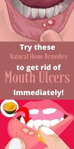 12 Natural Remedies For Mouth Sores That Work Naturalrelieved