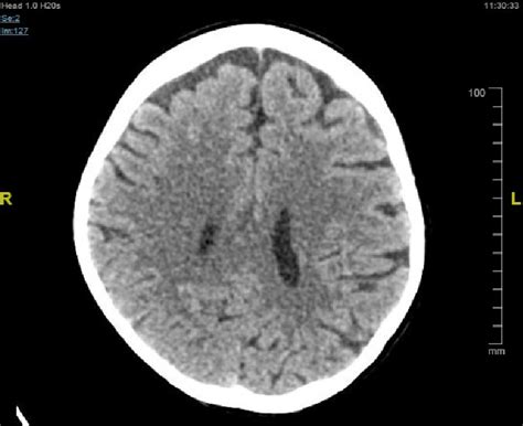 Ct Scan Shows Bilateral Frontal Brain Atrophy Download Scientific Diagram