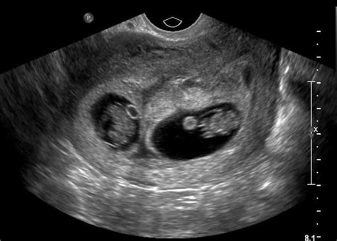 Ultrasounds Ultrasounds With Twins