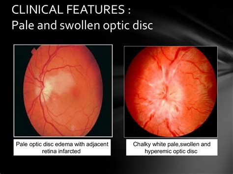 Aion Anterior Ischemic Optic Neuropathy